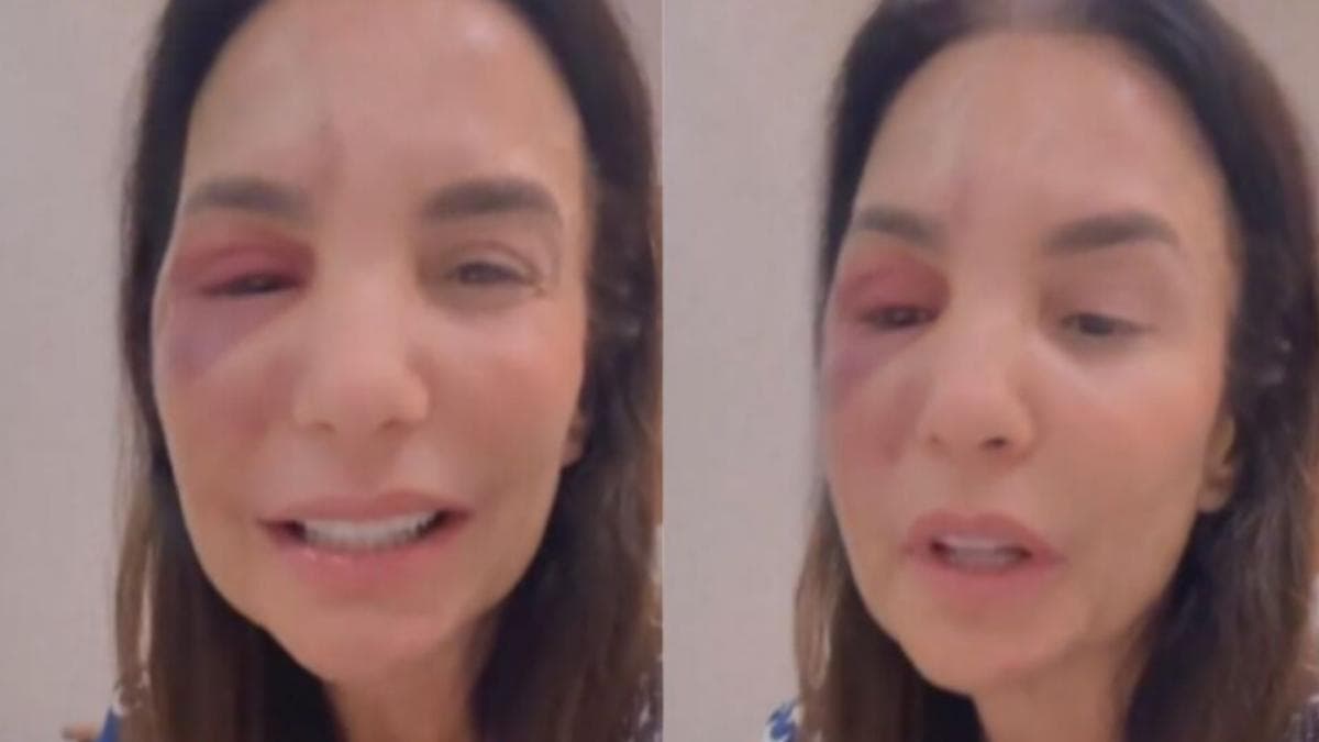 Ivete Sangalo reaparece após cirurgia delicada e tranquiliza fãs
